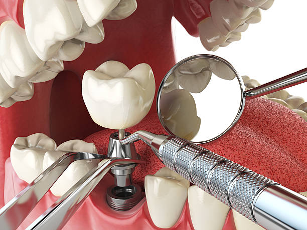 Best Broken or Cracked Tooth Emergency Dentist in USA